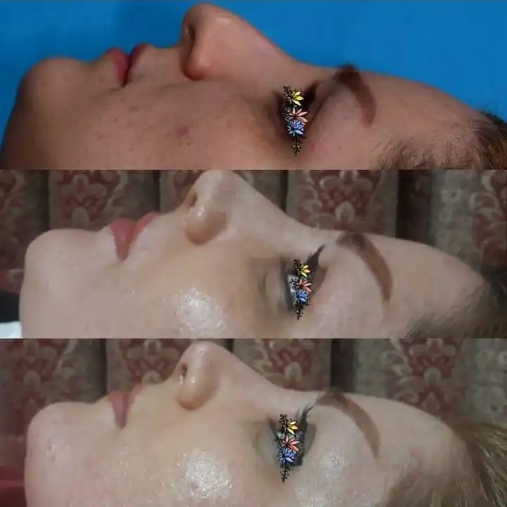 جراحی زیبایی و درمانی بینی - مجموعه A